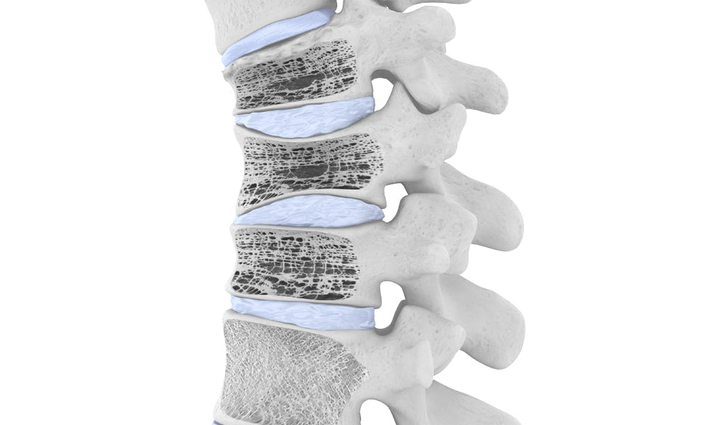 Spinal Osteoporosis - Bauerfeind United Kingdom