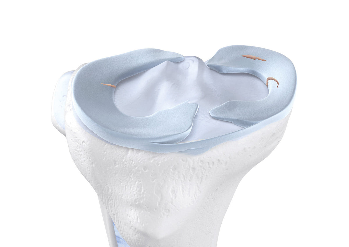 Meniscus Tear - Bauerfeind United Kingdom