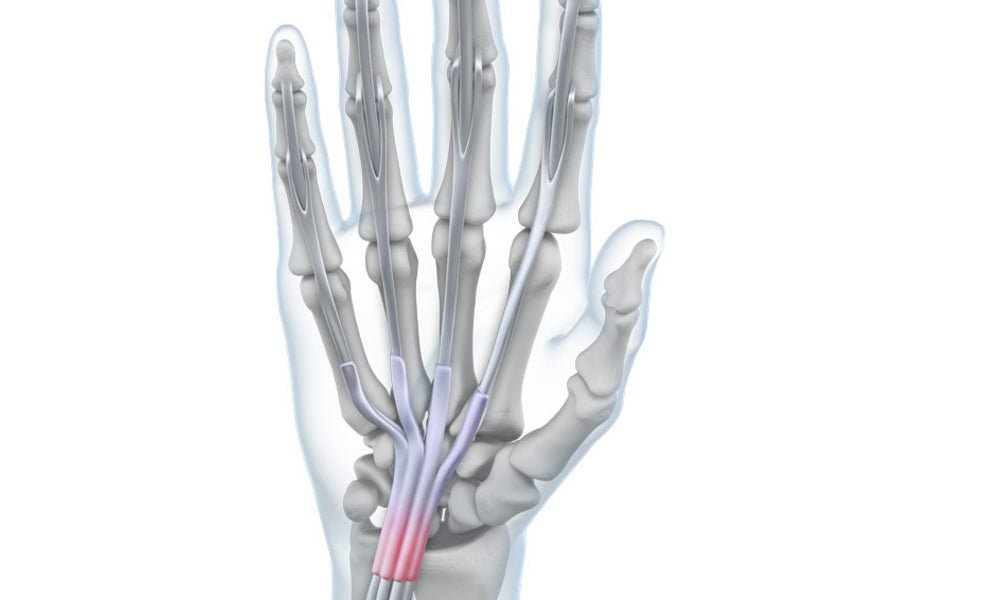 Tendonitis - Bauerfeind United Kingdom