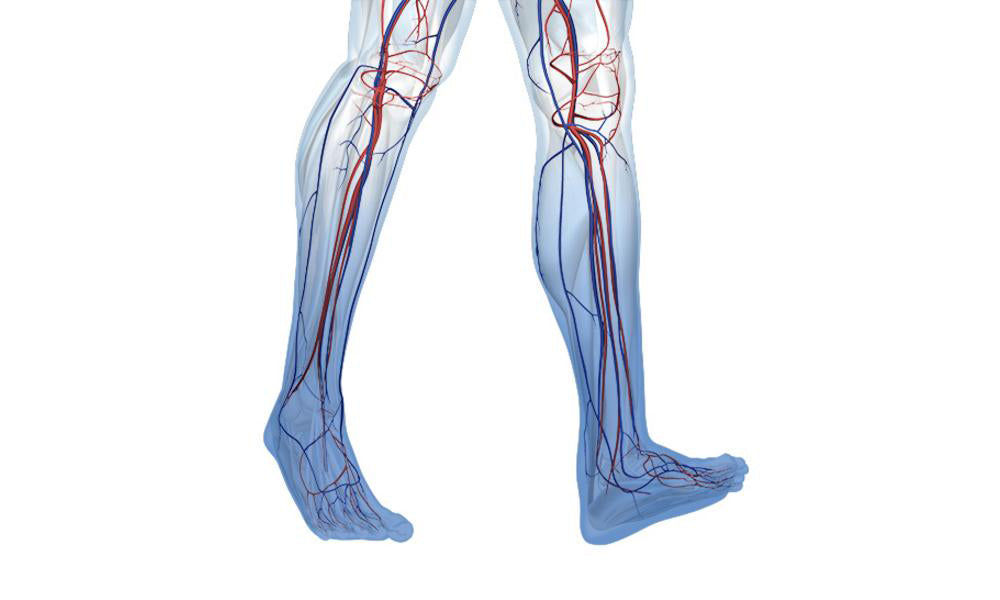 Chronic Venous Insufficiency (CVI) - Causes, Diagnosis and Treatment - Bauerfeind United Kingdom