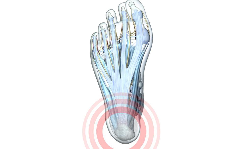 Heel Pain - Causes, Diagnosis, Symptoms & Treatment - Bauerfeind United Kingdom