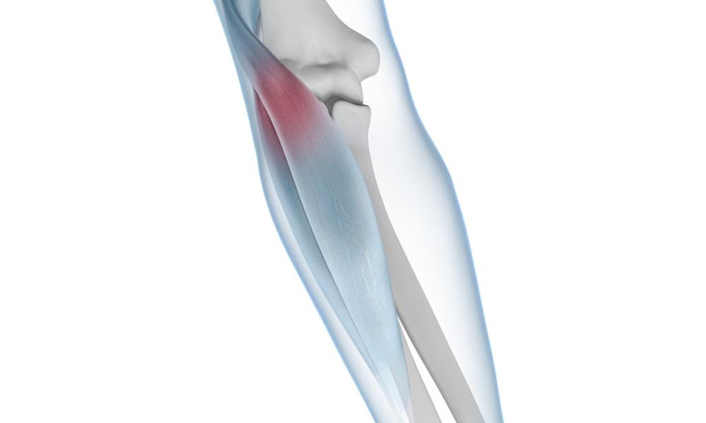 Tennis Elbow - Bauerfeind United Kingdom